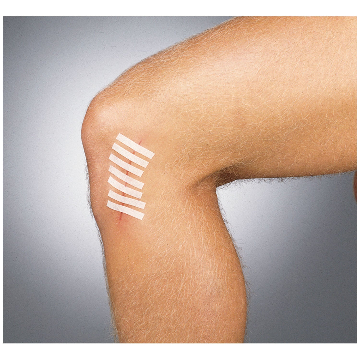 GENTELL SUTURE STRIP® WOUND CLOSURE STRIPS "Wound Closure Strips, 1/8\" x 3\", 5/pouch, 50 pch/bx"